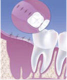 Foto rimozione dentale